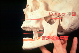 総入れ歯　噛み合わせの再構築